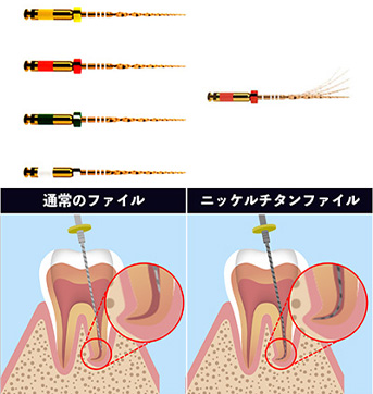 ニッケルチタンファイル